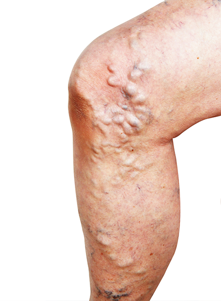 Large and severe varicose veins